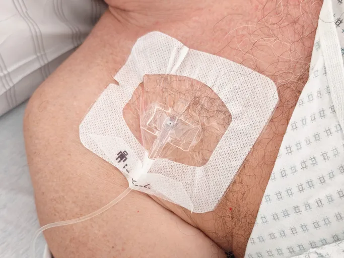 A subcutaneous venous port on the breast of an oncological patient under a sterile bandage. Oncology, chemotherapy, cancer treatment, medical care.